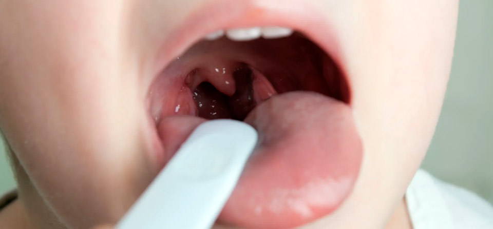 Como identificar placas na garganta de um paciente